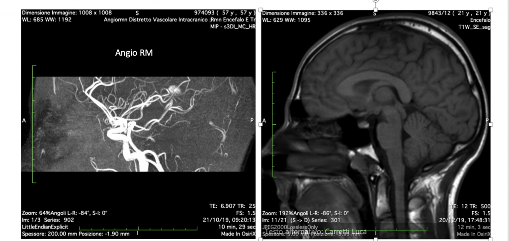 RM encefalo in proizione sagittale e angio-RM vasi intracranici
